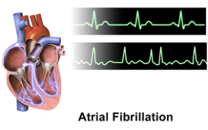 Atrial_Fibrillation