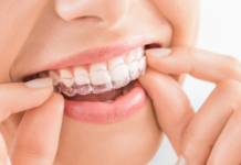 Invisalign vs Braces in Singapore: Which Is Better for You?